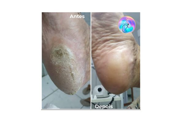 Foto de antes e depois do tratamento 10